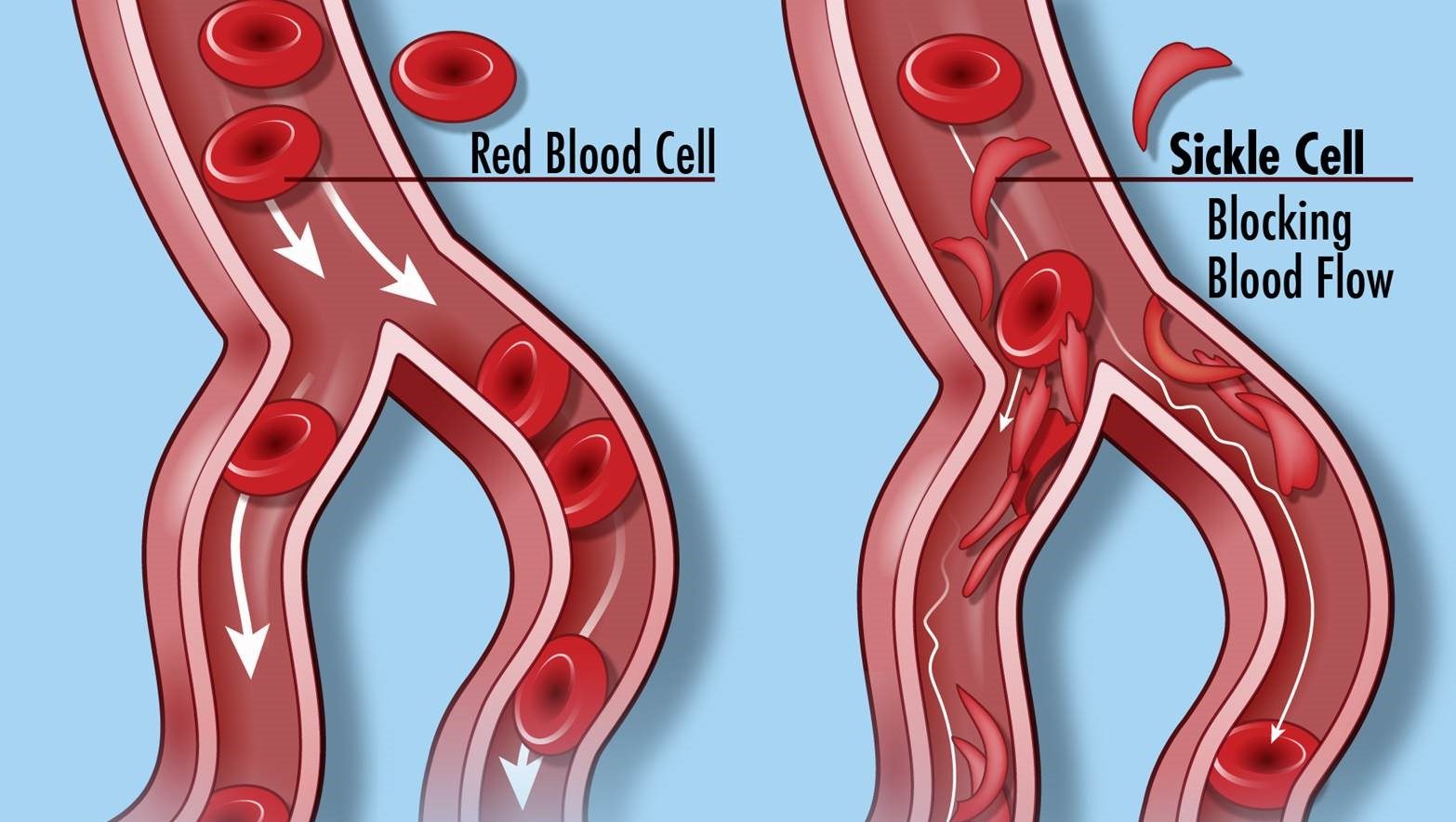 uct-professor-s-research-offers-hope-of-treatment-for-sickle-cell